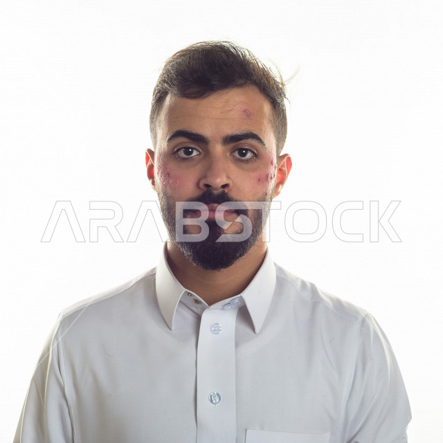 بورتريه لرجل سعودي خليجي مصاب بعدة مشاكل في منطقة الوجه، التعرض للحروق ،  بثور وجه منتشرة على البشرة ، ايماءات و تعبيرات وجه و يدين تدل على الآلم و الحزن ، مشاكل صحية و اصابات جسدية ، خلفية بيضاء