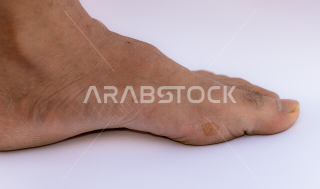 الورم الحليمي الجلدي البشري، عدوى فيروسية تسبب ظهور زوائد على سطح البشرة (ثآليل)، الأمراض الجلدية المعدية، دمامل جلدية حميدة، صورة مقربة لقدم رجل عربي خليجي سعودي مصاب بفايروس  الحبل الأكرودوني