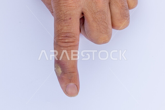 ضرورة زيارة طبيب الجلدية للعلاج والجراحة، نتائج الاصابات البسيطة والوخز بالإبر، الأمراض الجلدية البشرية، صورة مقربة ليد رجل عربي خليجي سعودي مصاب بخراج في اصبعه، تجمع القيح في البشرة و النسيج تحت الجلد