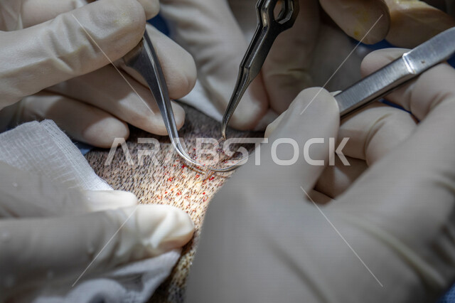 Close-up of a group of doctors performing a hair transplant, operating room, medical equipment and tools, surgery, head hair transplant